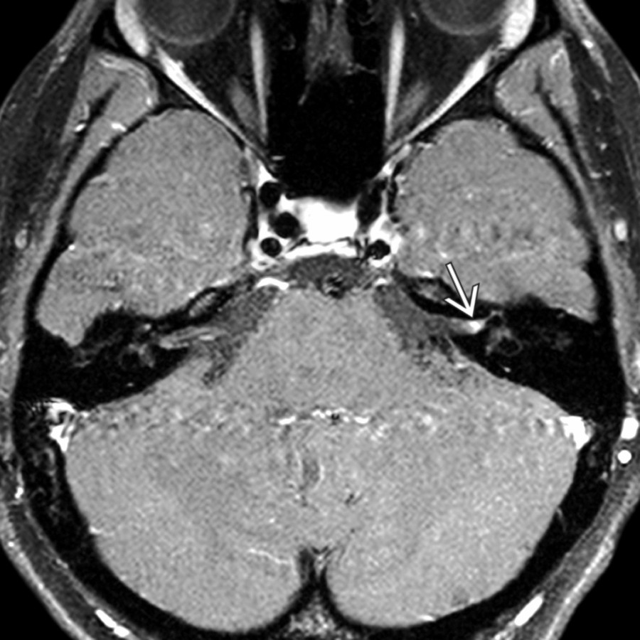 Axial T1 C+ FS MR shows a "tuft" sign  in this patient with acute onset of left peripheral CNVII paralysis. The enhancing fundal portion of the IAC CNVII often has this diffuse, less linear appearance.