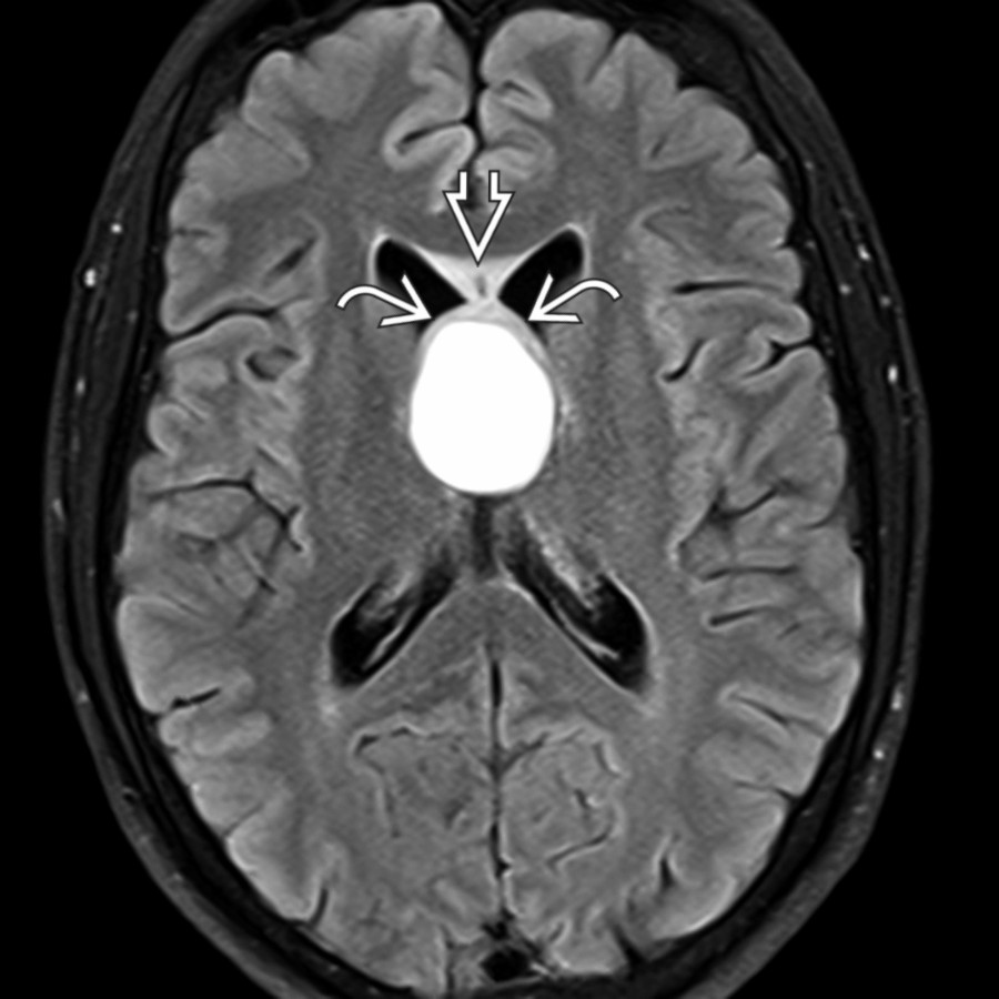 Axial FLAIR MR shows the cyst is extremely hyperintense and does not suppress. Note hyperintensity in the fornices  and adjacent corpus callosum genu , suggesting edema from acute inflammation.