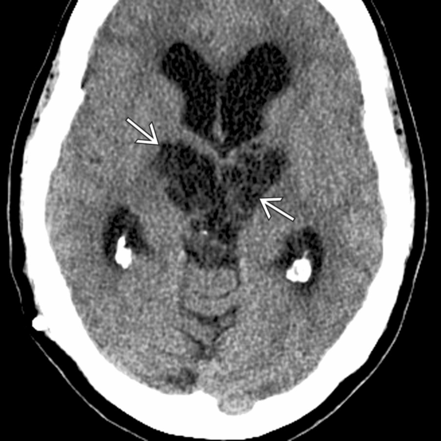 Axial NECT shows multiple clusters of CSF-like cysts . These are actually in brain parenchyma, helping distinguish them from other suprasellar cystic lesions.