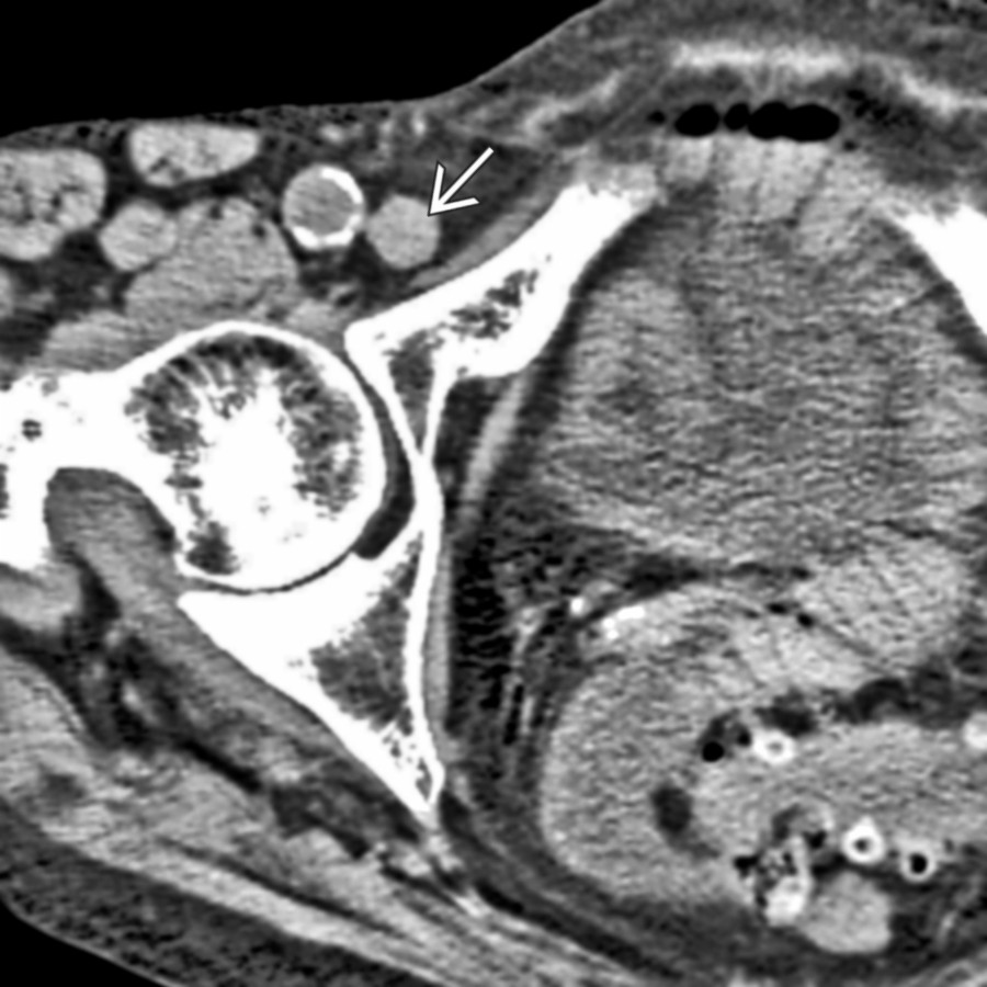 Axial CECT shows a femoral hernia with a small bowel obstruction. Note the loop of bowel entrapped in the right femoral canal .