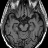 Axial T1WI MR in the same patient 3 years later shows more prominent medial temporal lobe atrophy as well as enlargement of parahippocampal fissures. In addition, diffuse cerebral atrophy has progressed further. The patient was diagnosed as probable AD.