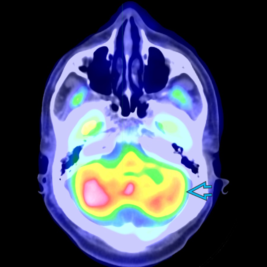 Axial fused PET/CT in the same patient shows asymmetric decreased FDG uptake in the left cerebellum  suggests contralateral right lateralization (i.e., nonlateralizing).