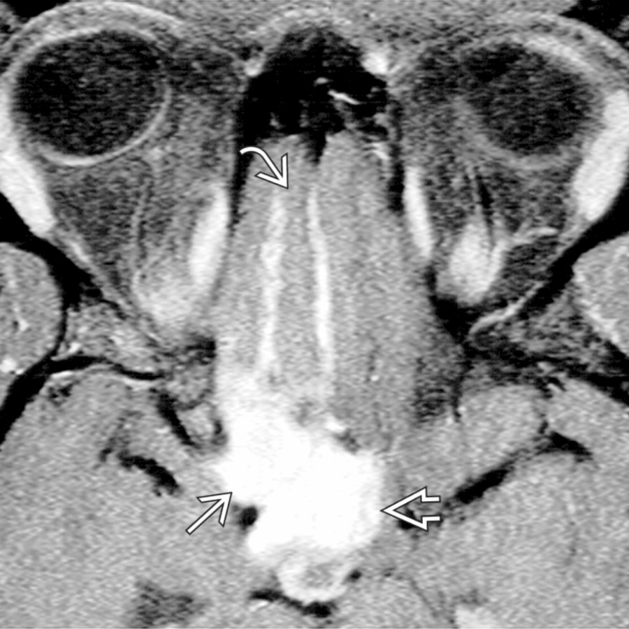 Axial T1 C+ FS MR shows an enhancing suprasellar mass involving the optic chiasm  and hypothalamus  with pial enhancement along the inferior frontal lobe . The lesion also involved the optic nerve.