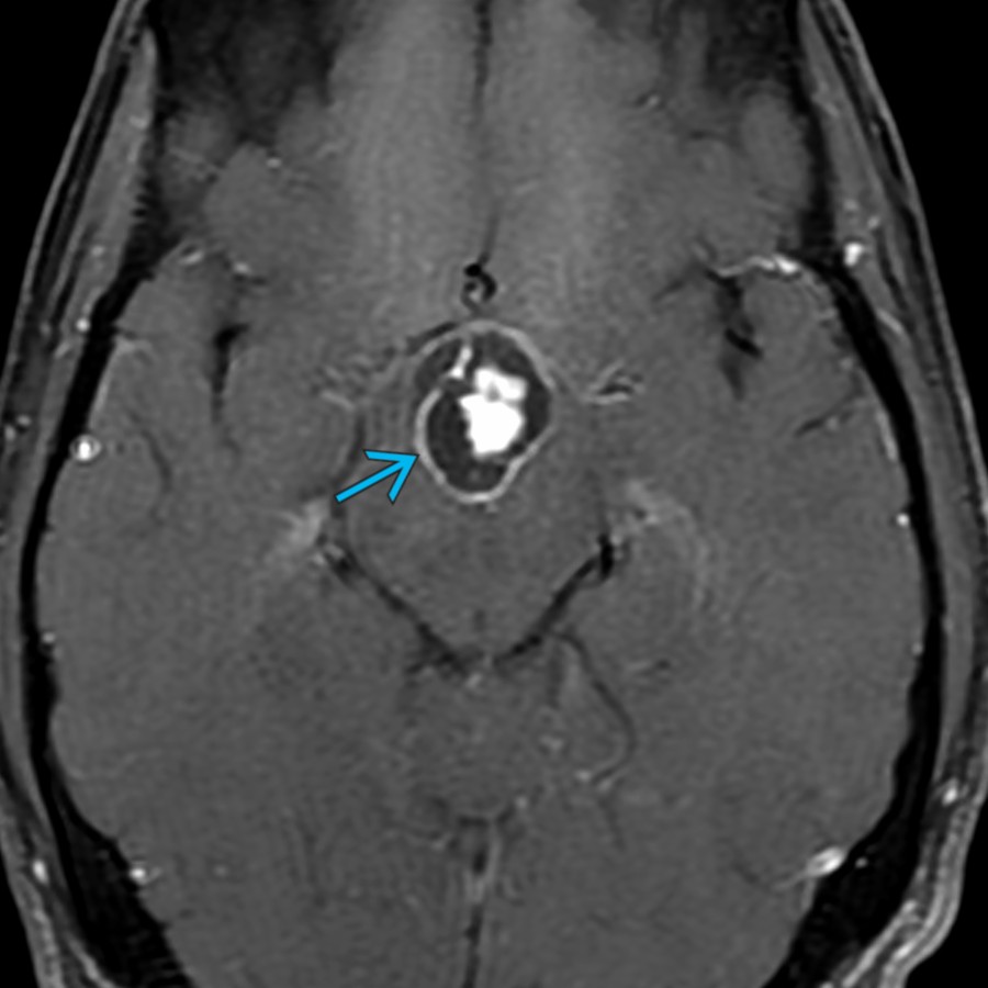 Axial T1 C+ FS MR shows a cystic and solid suprasellar enhancing mass . In an adult, craniopharyngiomas may be adamantinomatous or papillary types. Adamantinomatous craniopharyngiomas enhance, calcify, and have cysts. Papillary craniopharyngiomas are commonly solid and  enhancing. These are WHO grade 1 tumors.