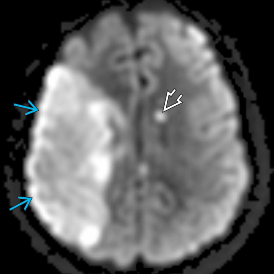 Axial DWI MR in the same patient confirms restricted diffusion in the right MCA territory . Also note the focus of restricted diffusion in the left periventricular region . Multiple infarcts in multiple vascular territories should raise suspicion of a proximal embolic source.