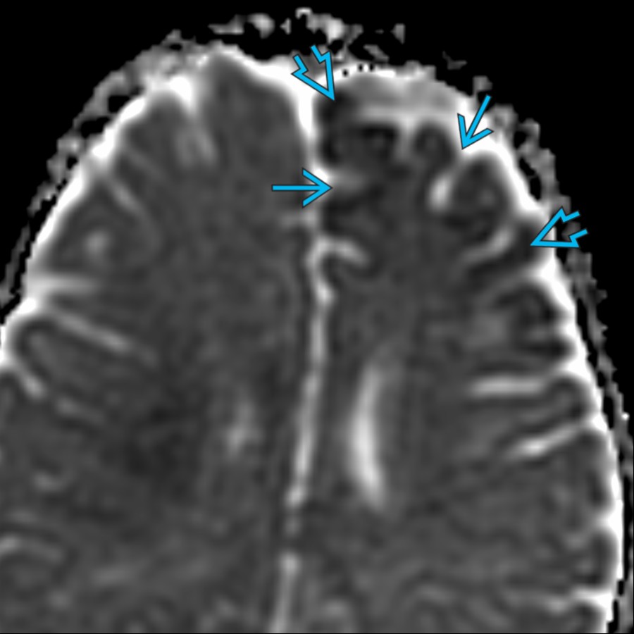 Axial ADC map in the same patient shows modestly ↓ ADC  within the affected cortex but resolution of acute gyral swelling, as evidenced by prominent sulci , suggesting the infarct is in the subacute phase.