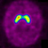Axial I-123 ioflupane SPECT shows bilateral a comma-shaped appearance, consistent with a normal study. Note the slight asymmetry between sides, which may be secondary to head positioning.