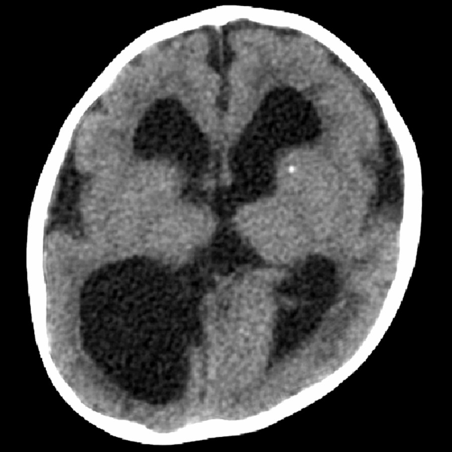 Axial NECT shows marked atrophy & minimal BG Ca⁺⁺ in this child with congenital CMV. The Ca⁺⁺ seen in CMV is typically asymmetric & associated with migrational abnormalities & microcephaly.