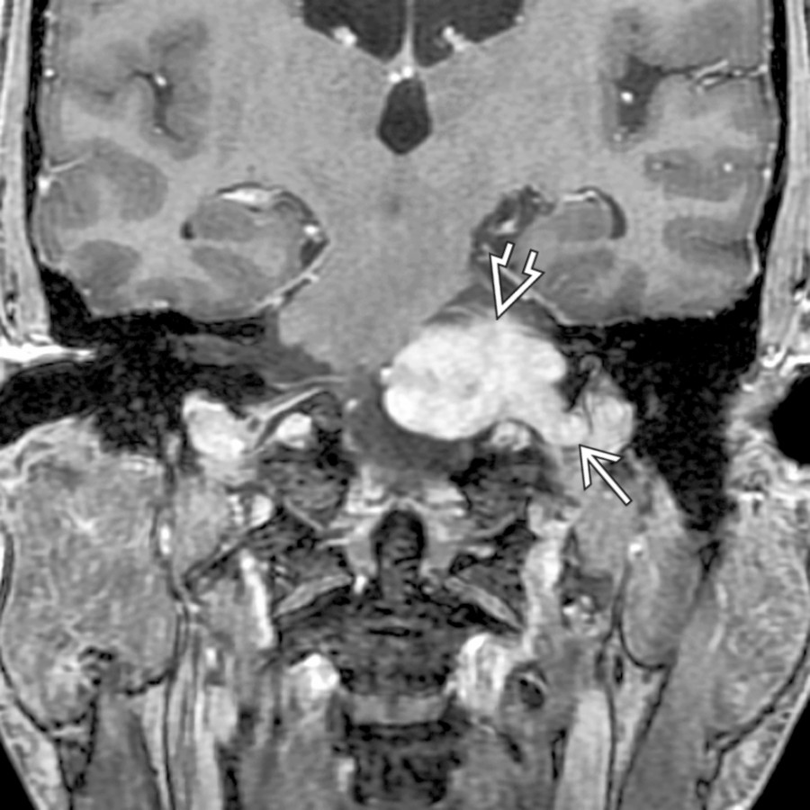 Coronal T1 C+ MR reveals an enhancing schwannoma in the jugular foramen . The tumor projects superomedially to fill the CPA cistern  and compress the brainstem.
