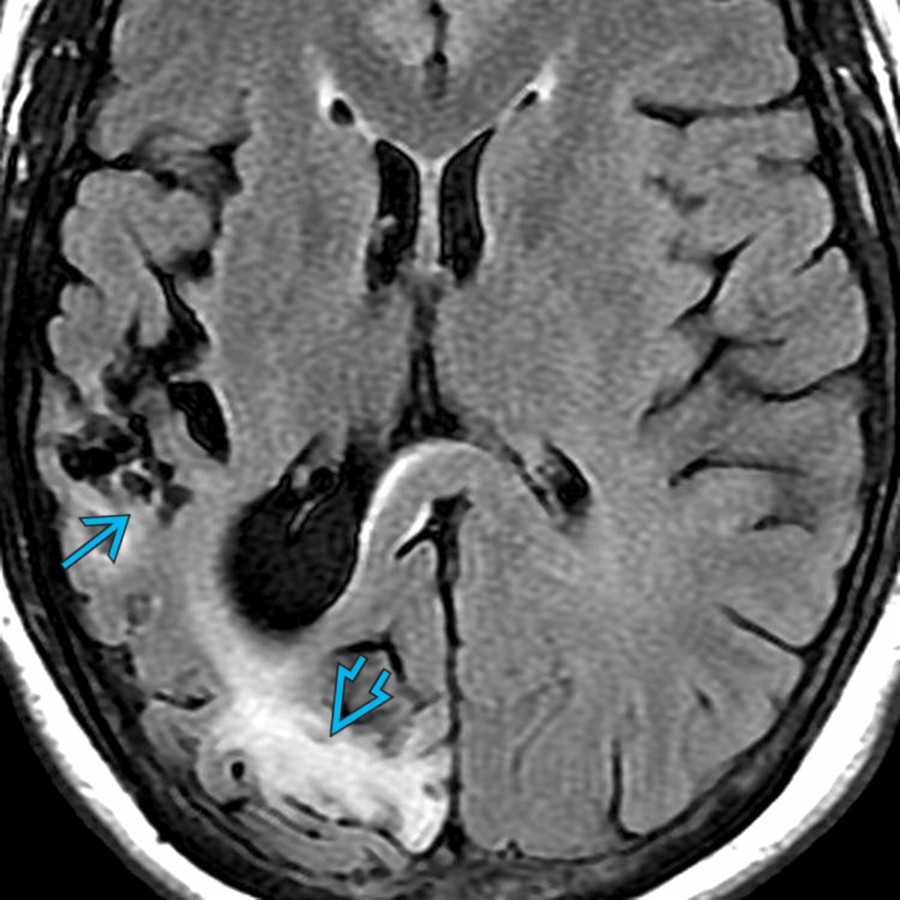 Axial FLAIR MR in the same patient after 1 year shows cystic encephalomalacia , gliosis , and volume loss in the same regions. Although in most cases imaging findings of SE are reversible, persistent imaging abnormalities, such as focal atrophy due to permanent neuronal damage, can occur, as in this case.