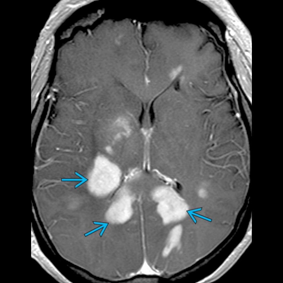Axial T1 C+ MR in a young male patient with rapid onset of visual disturbance demonstrates large enhancing demyelinating lesions  in the deep and periventricular white matter. Marburg disease is an acute fulminant MS variant.