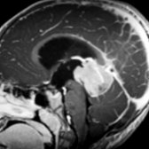 Sagittal T1 C+ MR shows a large, enhancing mass in the pineal region . This was a pineoblastoma at resection. High-grade pineoblastomas are the most common pineal parenchymal tumor.