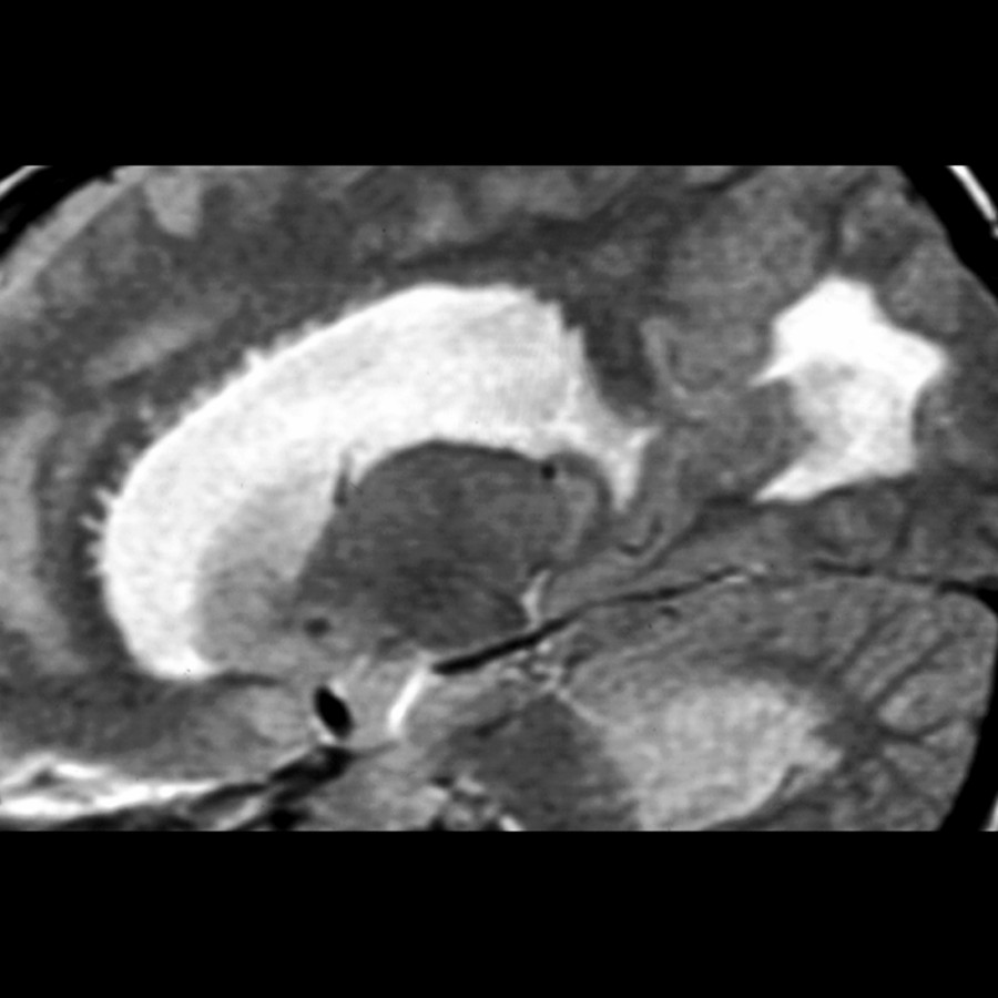 Sagittal T2 MR in the same patient shows transependymal CSF flow, seen here as "fingers" extending into white matter around the enlarged lateral ventricle. The case was medulloblastoma with acute IVOH.