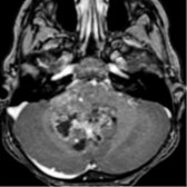 Axial T1 C+ MR shows a heterogeneously enhancing mass extending through right foramen of Luschka  in this posterior fossa type A (PFA) ependymoma, which are more laterally located and have a worse prognosis compared to posterior fossa type B.