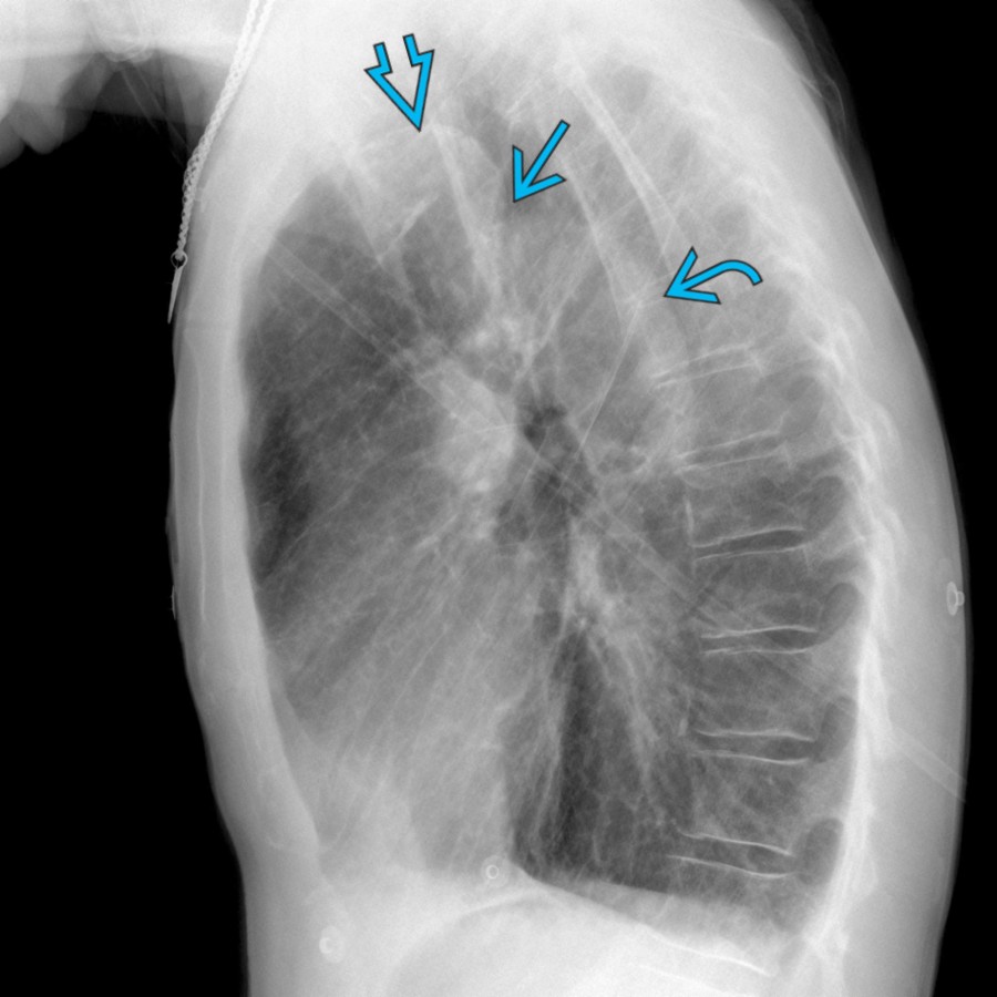 Lateral radiograph shows elongation and superior extension of the aortic arch , which then courses inferiorly with kinking   before taking its normal course . These findings are highly suggestive of pseudocoarctation.