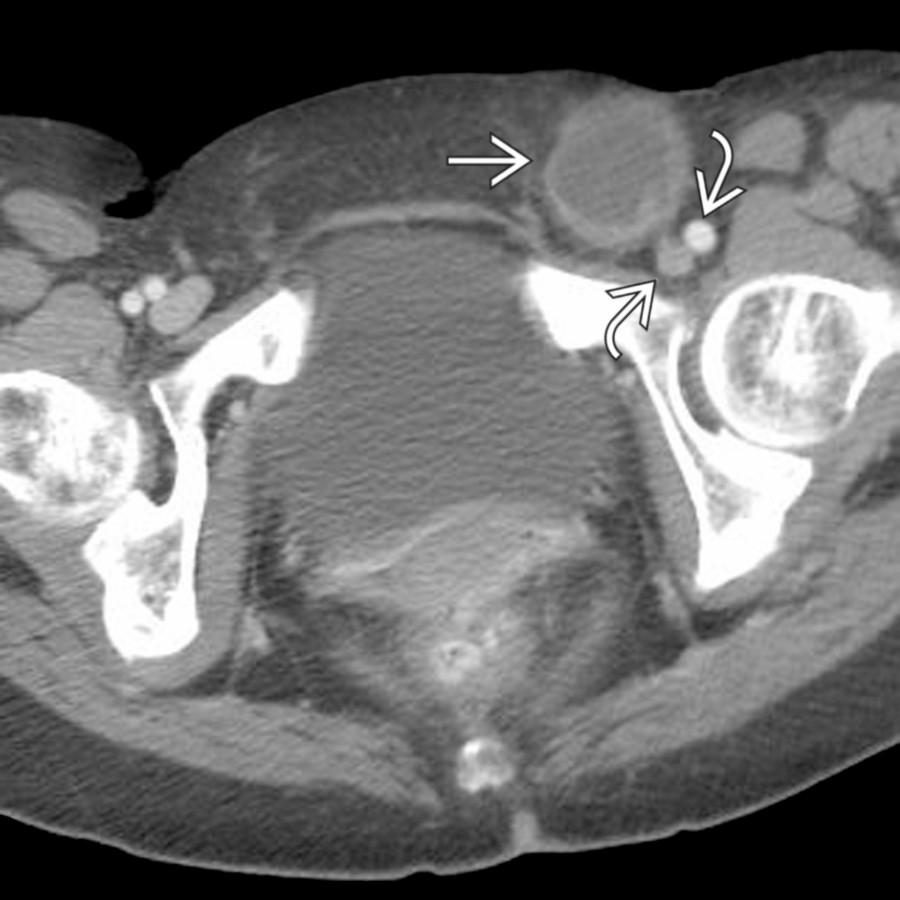 Axial CECT demonstrates the typical position of a femoral hernia . Note that the herniated loop of small bowel lies just medial to the femoral vessels  .