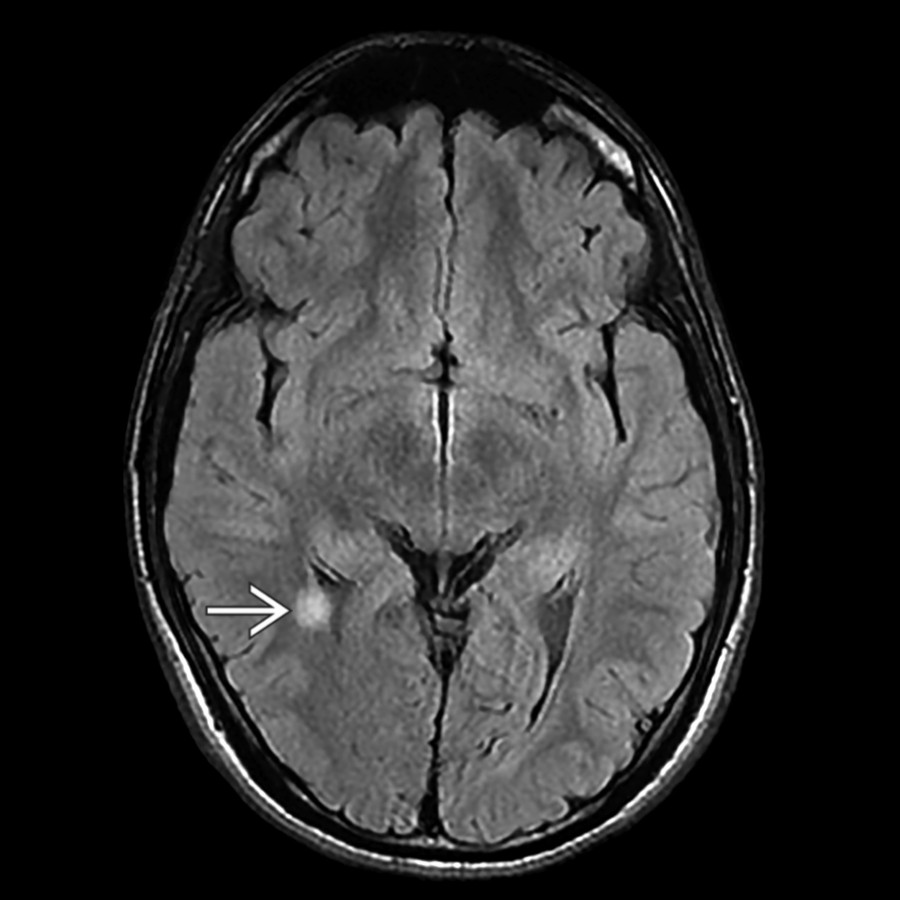 Axial FLAIR MR in a teen patient with acute extremity sensory changes and visual disturbance shows a focal periventricular T2-hyperintense lesion . Imaging also showed additional periventricular and callosal-septal lesions (not shown).