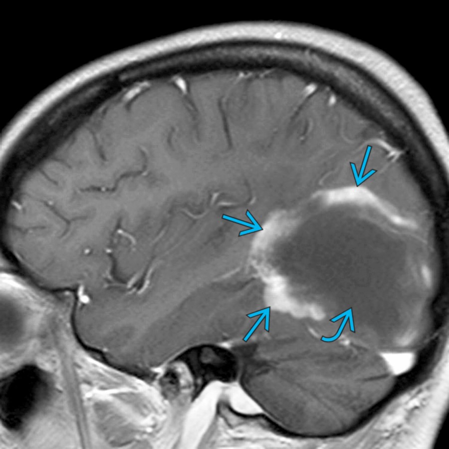 Sagittal T1 C+ MR shows a large,  hypointense mass  with a peripheral crescent of incomplete or open ring enhancement . This enhancement pattern is classic for a tumefactive demyelinating disease, most commonly MS.