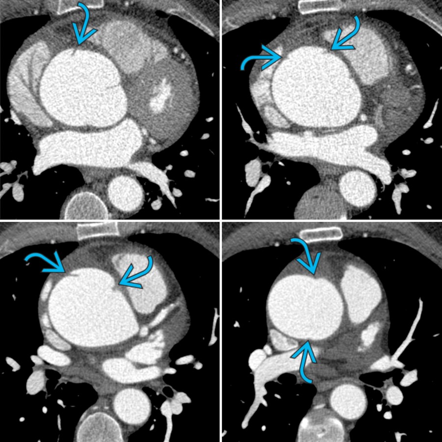 Axial ECG gated images of a limited intimal tear (LIT) show contour irregularities in the ascending aorta, which correspond to the undermined edges  of a large LIT. (Courtesy Chin et al.)