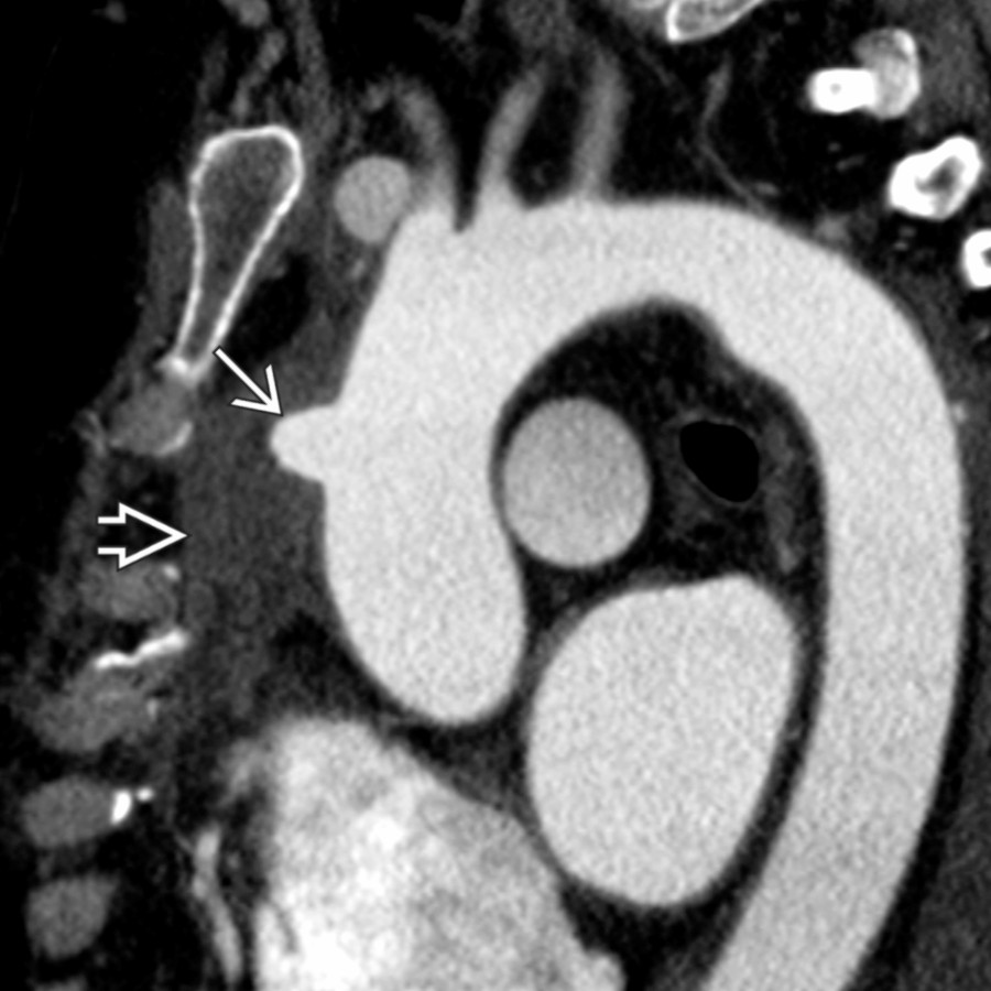 Oblique CTA of the thoracic aorta in the same patient shows a focal, eccentric pseudoaneurysm  along the anterior wall of the ascending aorta with associated low-density soft tissue . These features are consistent with a mycotic aneurysm.