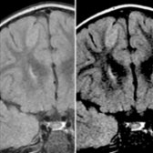 Coronal FLAIR MR images in a 3-year-old with FCD type IIb   with varying contrast windowing are shown. Note how FCD is much more conspicuous in the image on the right with windowing emphasizing greater contrast. Windowing is an important means to increasing detection of subtle FCD lesions.
