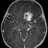 Axial T1 C+ MR shows a heterogeneous mass in the inferior left frontal lobe . This was an atypical teratoid-rhabdoid tumor at resection. DWI images demonstrate decreased diffusion (not shown), consistent with a high-grade neoplasm.