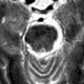Axial T2WI MR in a patient with a left middle cerebral artery infarct shows no abnormal signal in the pons, although diffusion revealed abnormality from WaD (not shown).