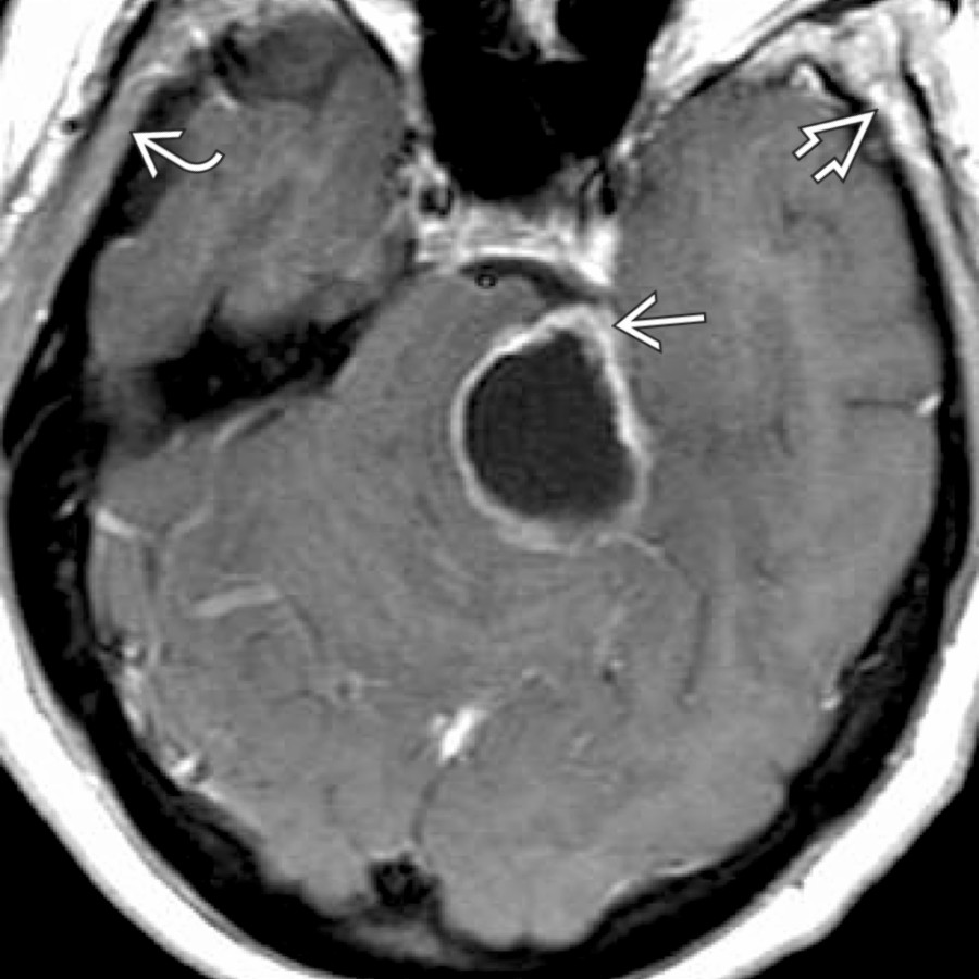 Axial T1 C+ MR demonstrates a large CPA cystic mass "pointing" toward the Meckel cave , providing a clue to the origin of this mass. Note chronic denervation changes of volume loss and fatty infiltration in the left suprazygomatic masticator space  compared to the right , partly seen here.