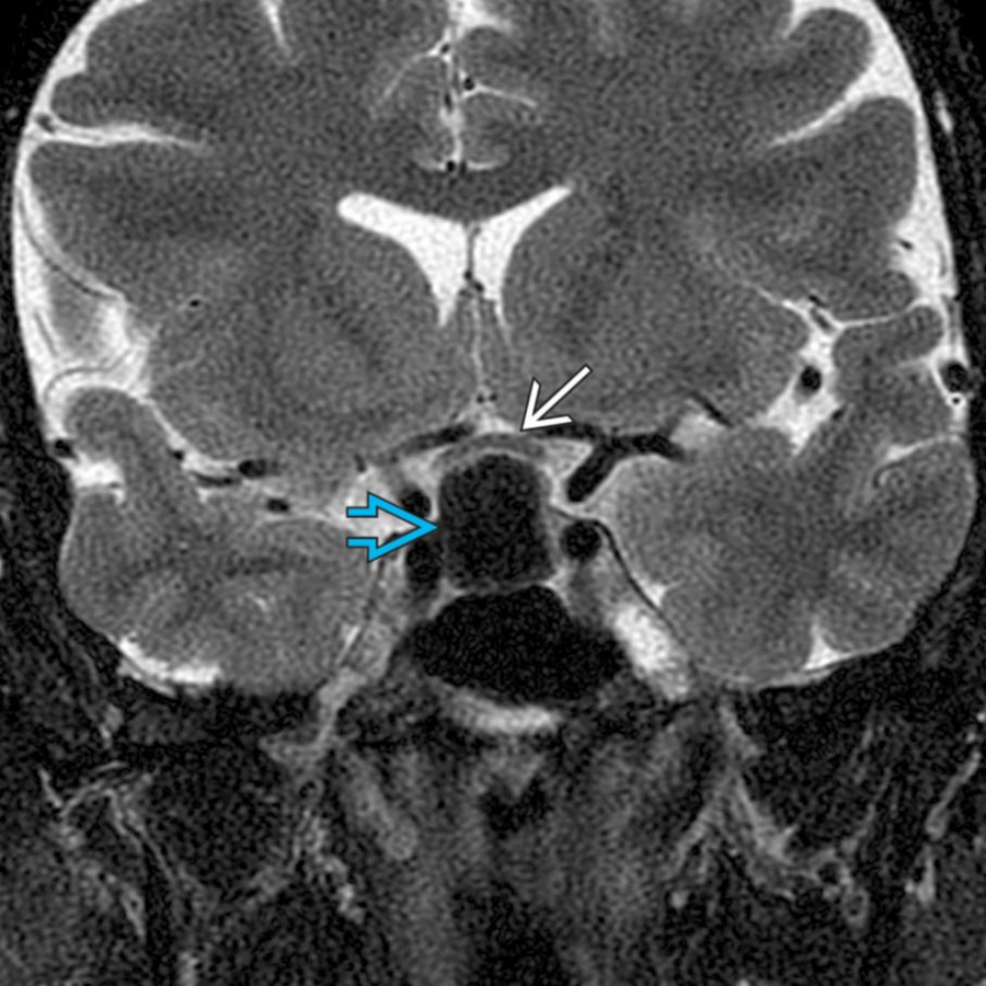 Coronal T2 MR in the same patient shows marked hypointensity within the cyst . Cyst contents may have variable signal.  There is mild mass effect and superior displacement of the optic chiasm  in this male patient who presented with visual changes.