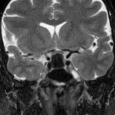 Coronal T2 MR in the same patient shows marked hypointensity within the cyst . Cyst contents may have variable signal.  There is mild mass effect and superior displacement of the optic chiasm  in this male patient who presented with visual changes.