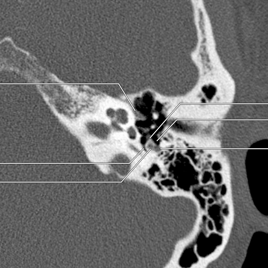 Mastoid segment extends ~ 13 mm from the posterior genu to the stylomastoid foramen, coursing inferiorly within the posterior wall of the middle ear cavity. The mastoid segment is related anteriorly to the facial nerve recess and medially to the stapedius muscle within the pyramidal eminence on the posterior wall of the middle ear cavity.