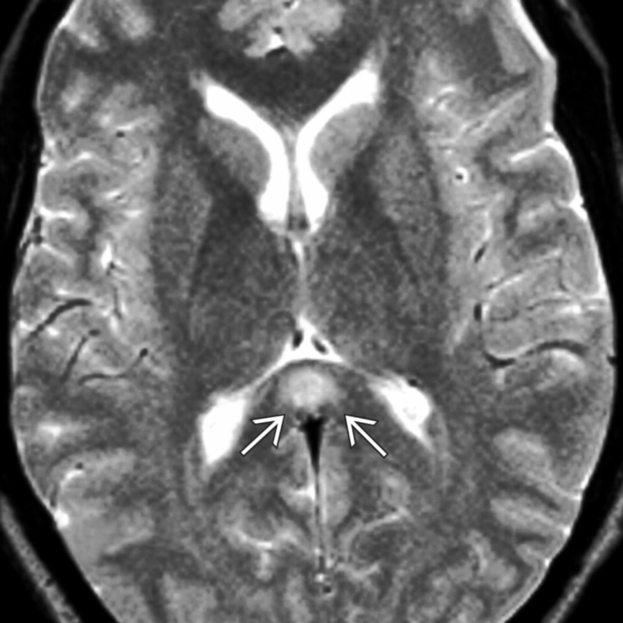 Axial T2WI MR shows focal hyperintensity in the splenium of the corpus callosum . The lesion completely resolved after the patient's seizures were treated. (Courtesy D. Mendelson, MD.)