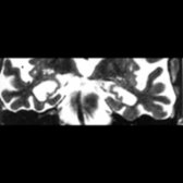 Coronal T2WI MR through the temporal lobes depicts marked atrophy of the hippocampi. (Courtesy J. Norfray, MD.)