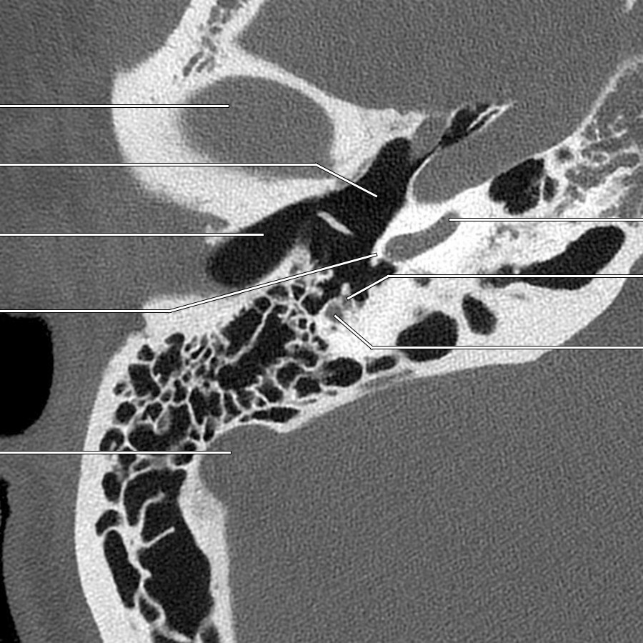 This image demonstrates the midmastoid segment of CNVII with adjacent chorda tympani.
