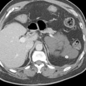 Axial CECT demonstrates a cystic mass  in the left retroperitoneum. The lesion abuts the pancreatic tail and left colon without appreciable mass effect. Note the presence of a coarse calcification    along the margin of the lesion.