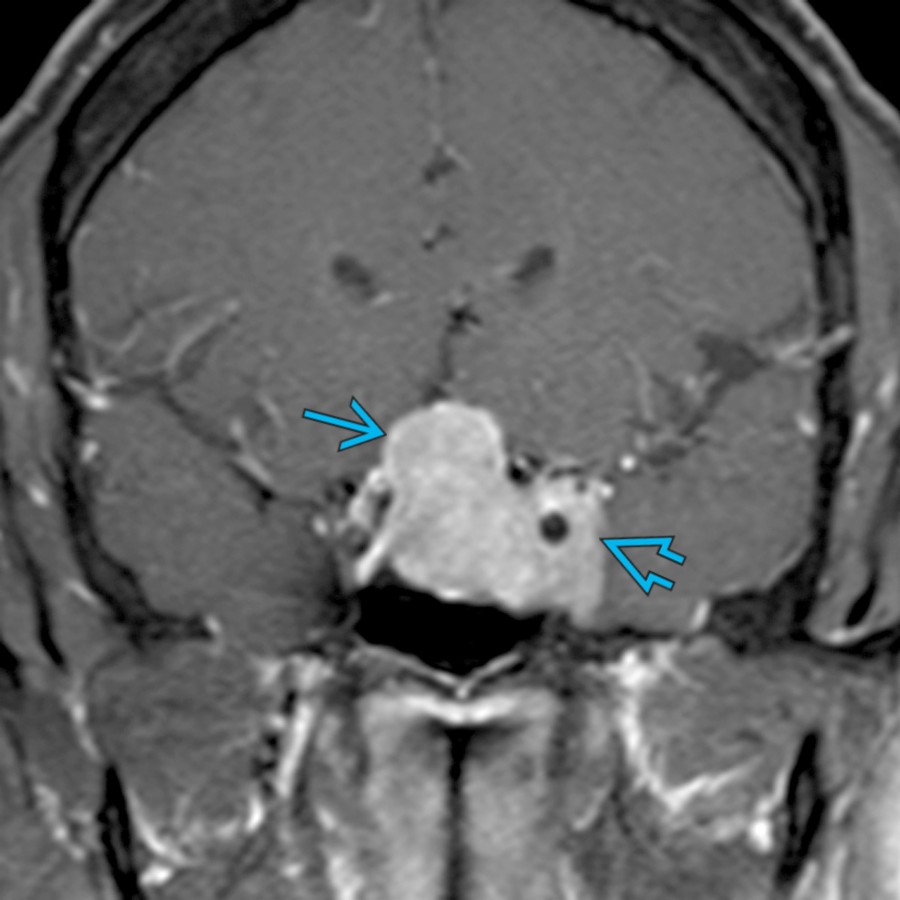 Coronal T1 C+ FS MR shows a large sellar and suprasellar mass  with encasement of the left cavernous carotid artery. The macroadenoma extends between the cavernous carotid artery and the lateral dura, indicating cavernous sinus invasion .