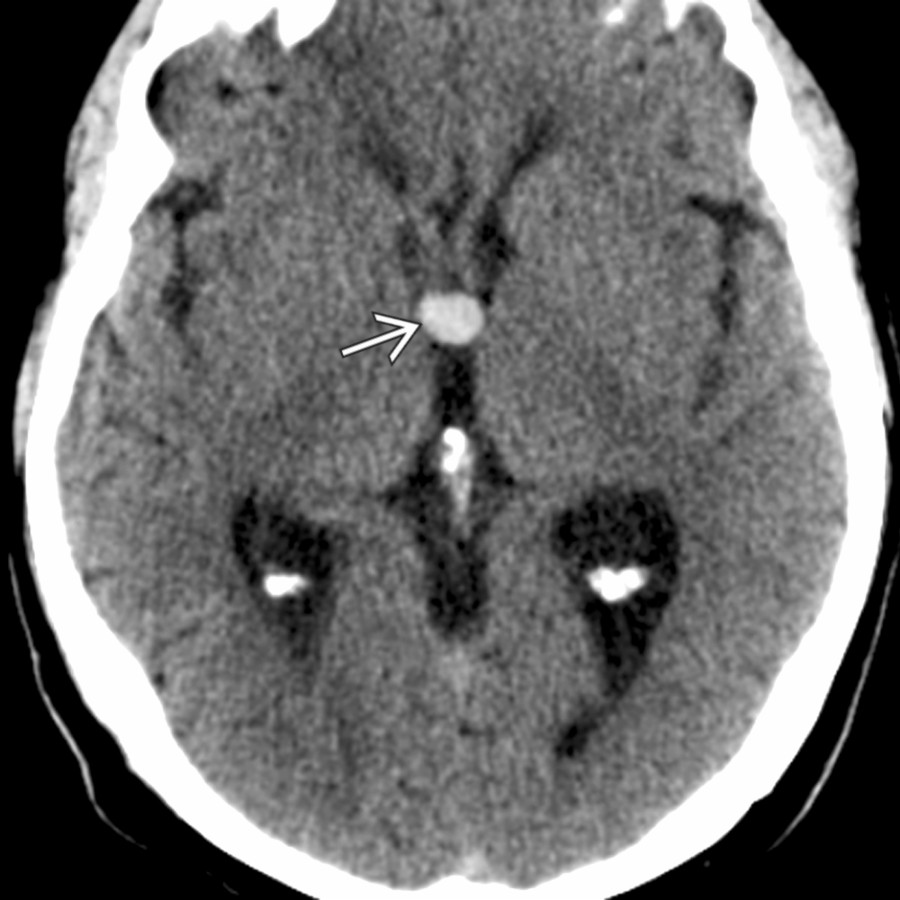 Axial NECT obtained to look for a subarachnoid hemorrhage in a 65-year-old man with a thunderclap headache shows a classic CC, seen here as a hyperdense mass  wedged into the foramen of Monro and upper 3rd ventricle.