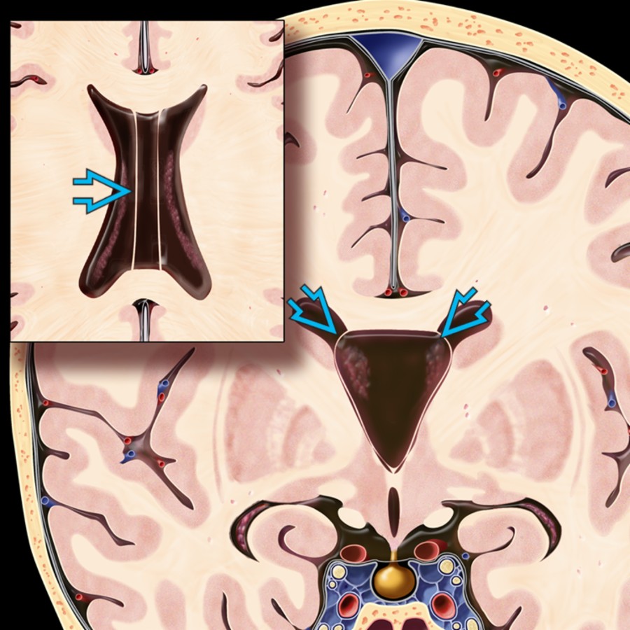 Coronal graphic with axial insert shows classic cavum septi pellucidi (CSP) with cavum vergae (CV) . Note the finger-like CSF collection between the lateral ventricles.