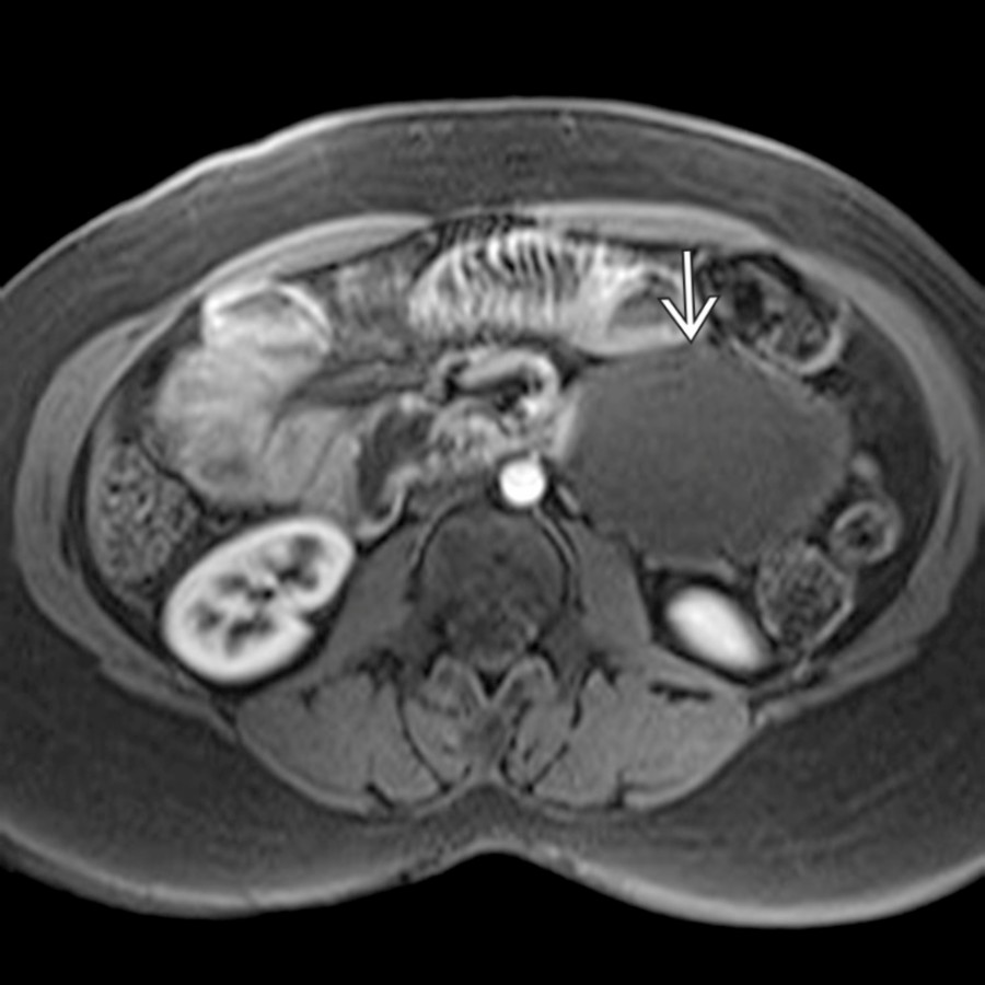 Axial T1 C+ MR in the same patient demonstrates the absence of any significant enhancement, mural nodularity, or solid component within the cystic lesion . The presence of any of these features should argue against the diagnosis of a lymphangioma.