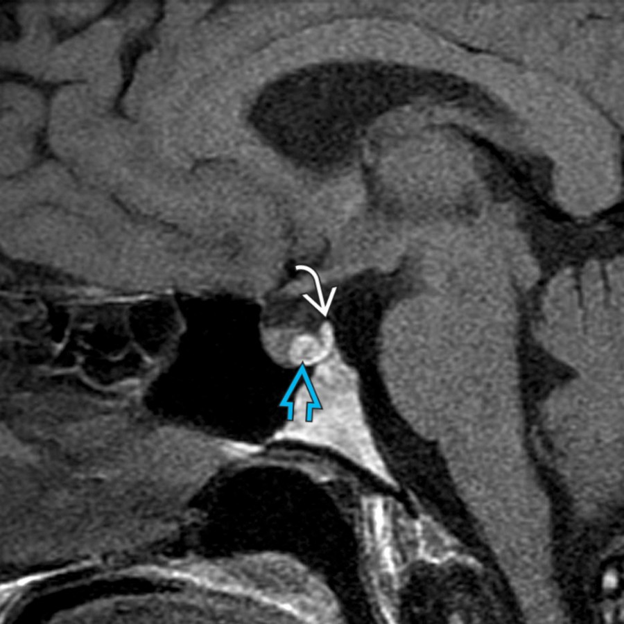 Sagittal T1 MR in a patient with amenorrhea shows a hyperintense mass within the pituitary gland  anterior to the normal hyperintense neurohypophysis . Imaging mimics a hemorrhagic pituitary microadenoma. Rathke cleft cyst was found at resection.