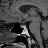 Sagittal T1 MR in a patient with amenorrhea shows a hyperintense mass within the pituitary gland  anterior to the normal hyperintense neurohypophysis . Imaging mimics a hemorrhagic pituitary microadenoma. Rathke cleft cyst was found at resection.