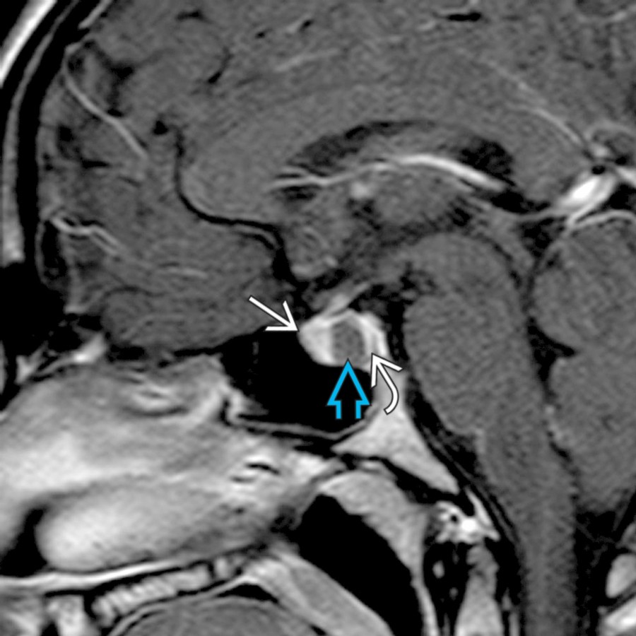 Sagittal T1 C+ MR shows typical appearance of Rathke cleft cyst  between normal adenohypophysis anteriorly  and neurohypophysis posteriorly . Small lesions may be managed conservatively.