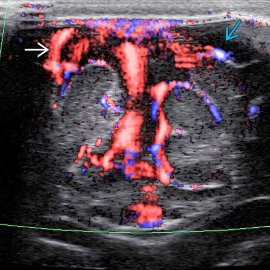 Coronal color Doppler US in a 4-month-old girl shows vessels  traversing the enlarged SAS . Doppler US can be helpful to exclude subdural collections by demonstrating normal veins in the SAS.