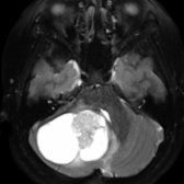 Axial T2 FS MR shows a solid tumor  with a cyst  in the right cerebellar hemisphere effacing the 4th ventricle . The solid component has relative increased T2 signal, suggesting a low-grade tumor.