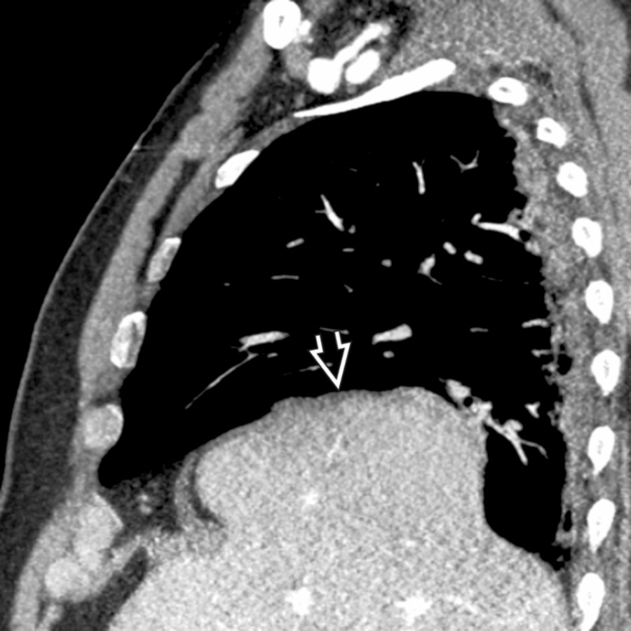 Sagittal CECT shows a focal bulge of the liver  through a weakened eventration of the right hemidiaphragm.