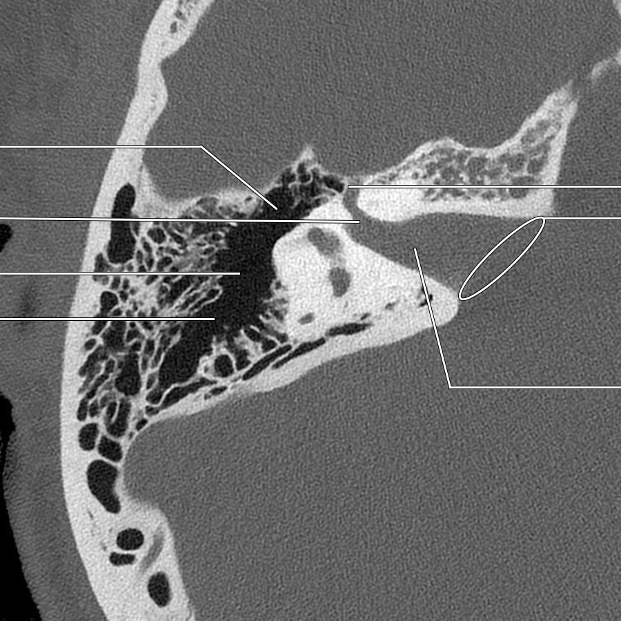 First of 5 high-resolution NECT bone window images of the right temporal bone from superior to inferior demonstrates the CNVII canal for the labyrinthine segment coursing anterolaterally from the fundus of the internal auditory canal (IAC) to the geniculate fossa. The labyrinthine segment is the shortest and narrowest segment.