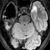 Axial FLAIR MR shows a large, thin-walled cyst  isointense to CSF in the right temporal pole in a patient previously treated for herpes simplex virus type 1 encephalitis. Areas of gliosis are present posterior to the cyst  and in the medial left temporal lobe .
