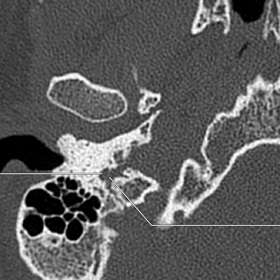 Last of 7 axial bone CT images shows the right facial nerve exiting the mastoid temporal bone at the stylomastoid foramen on its way to ramify within the parotid gland. Facial nerve perineural tumor spread from parotid malignancy should always be carefully evaluated.