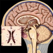 Sagittal graphic illustrates multiple sclerosis (MS) plaques involving the corpus callosum, pons, and spinal cord. Note the characteristic perpendicular orientation of the lesions  at the callososeptal interface along penetrating venules.