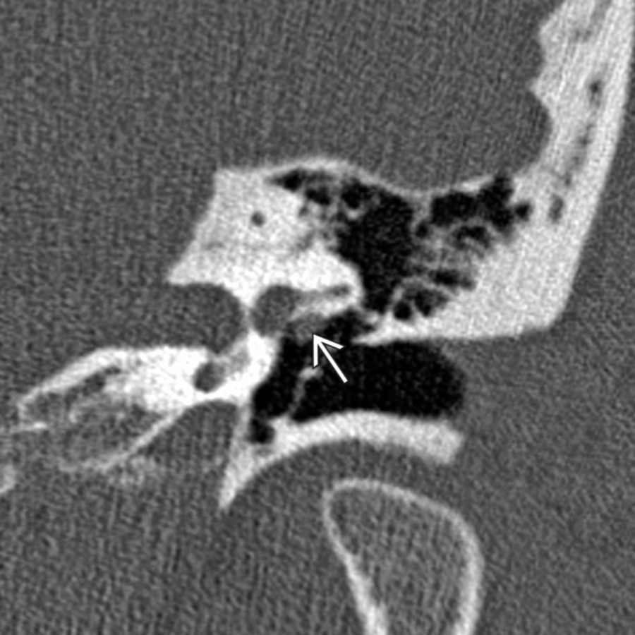 Coronal left ear temporal bone CT reveals a focal mass projecting from the midtympanic facial nerve . The lesion is prolapsed facial nerve, not a facial nerve schwannoma. Facial nerve prolapse can create significant surgical difficulties during stapedectomy.